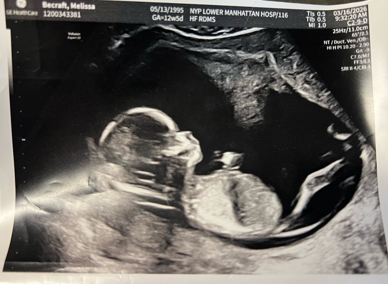 12-week ultrasound scan of Melissa and Luis's baby, profile view